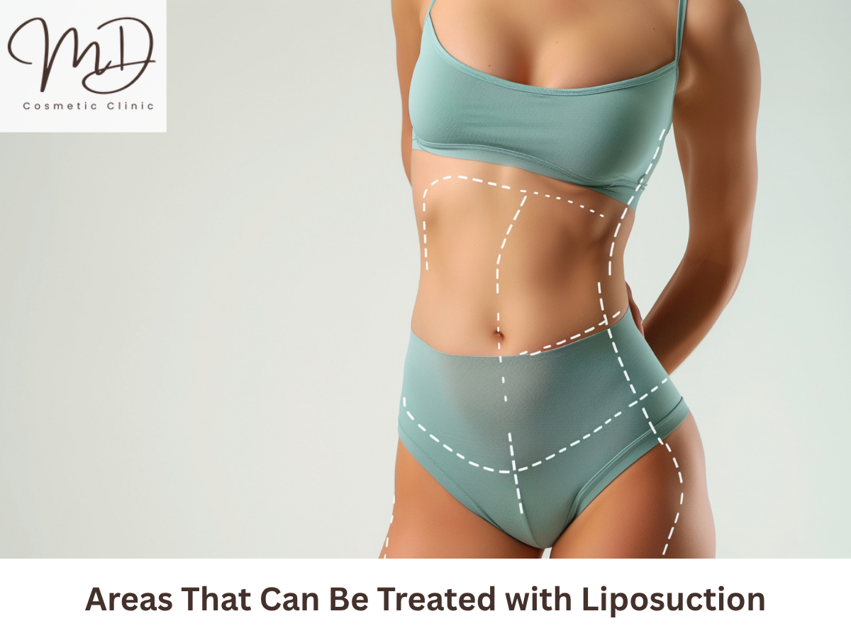 Liposuction