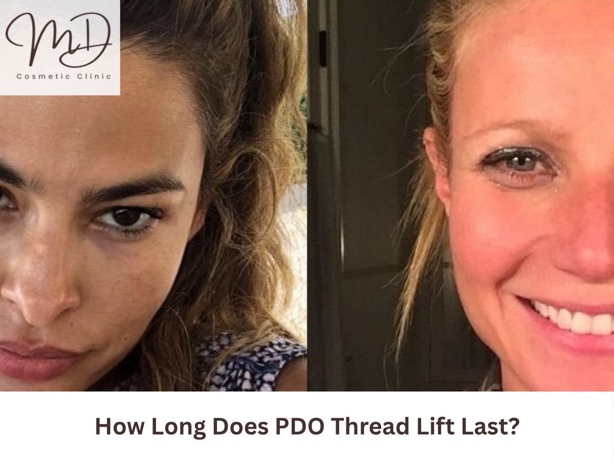 PDO Thread Lift