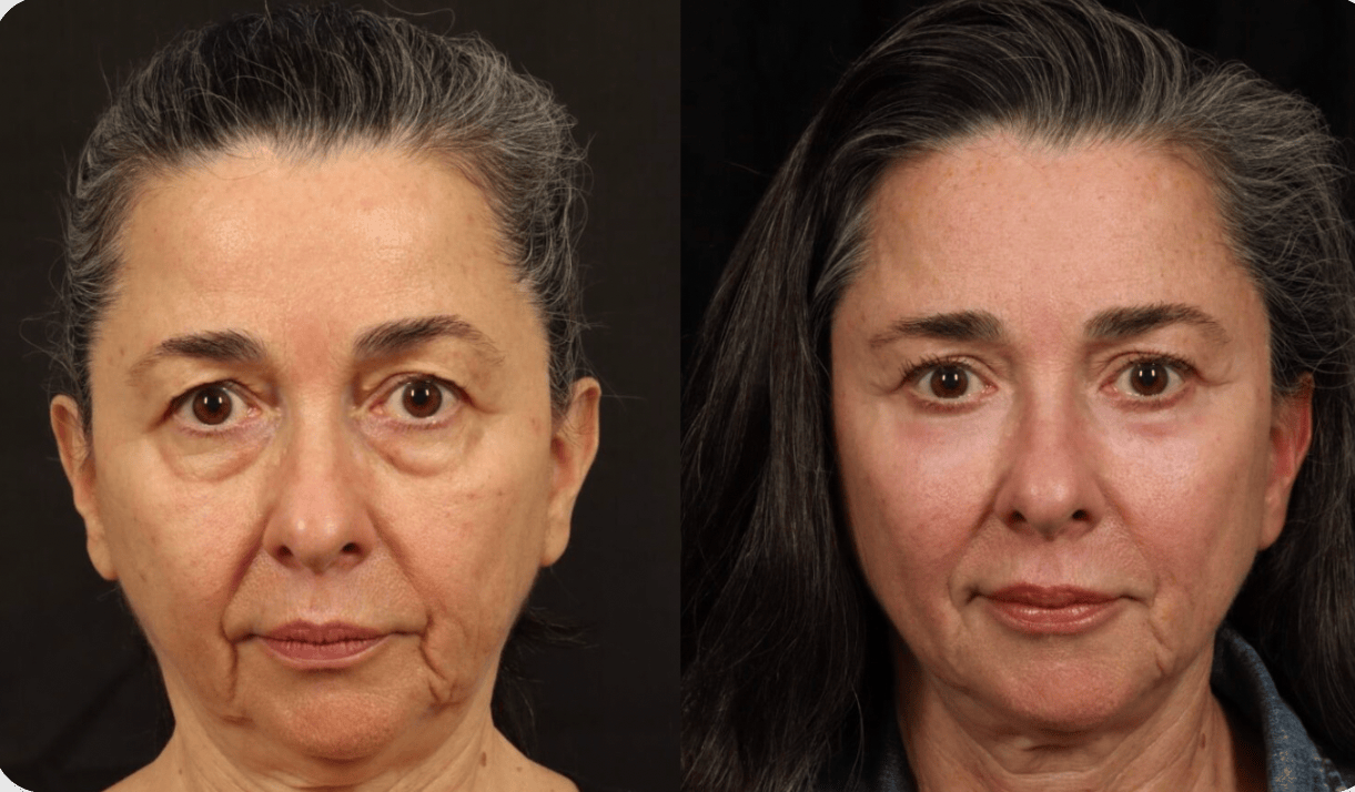 1727730576-midmicrofacelift-blog-image (1) Mid-Face Lifting