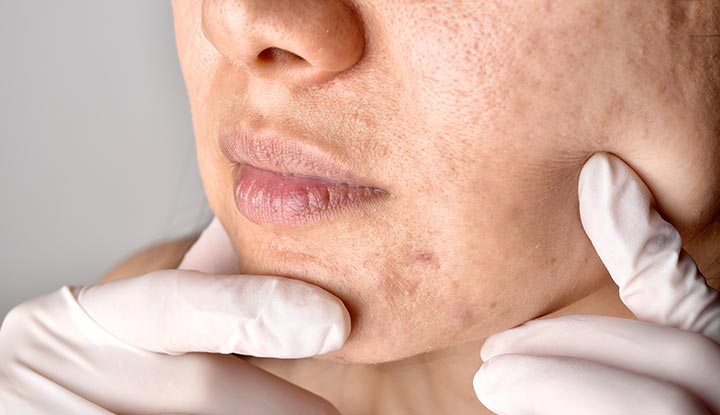 22773-clogged-pores_1254400415